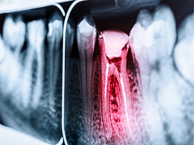 Factors that can affect treatment cost include the location of the infected tooth